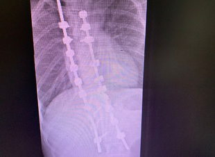 اجراء عملية جراحية معقدة بالعمود الفقري لطفل يبلغ من العمر 15 سنة بمستشفى الملك فهد بجدة