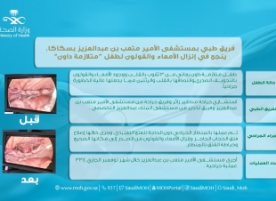 فريق طبي بمستشفى الأمير متعب بن عبدالعزيز بسكاكا, ينجح في إنزال الأمعاء والقولون لطفل “متلازمة داون”