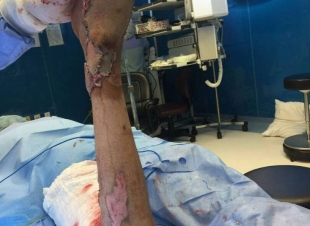 مستشفى الملك فهد بجدة ينجح في نقل شريحة جلدية لشاب سعودي تعرض لحادث مروري